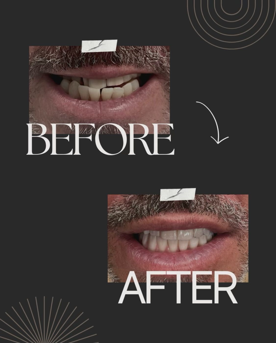 Before and after: broken front teeth restored